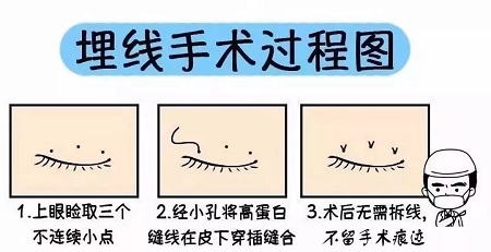 美眼張誠(chéng)坐診美萊，淺談為什么你的眼睛不夠美？
