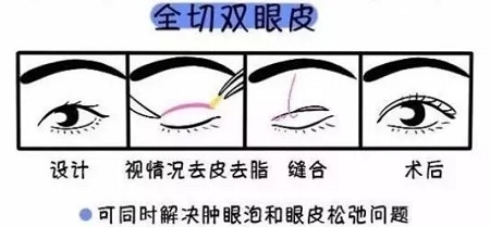美眼張誠(chéng)坐診美萊，淺談為什么你的眼睛不夠美？