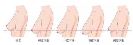 一味追求大胸的她們，卻忽略了這個問題...