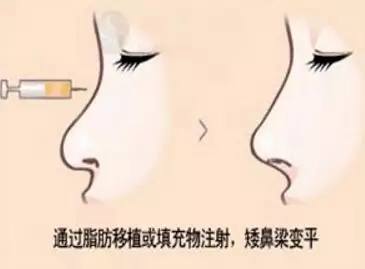 想知道身邊人有沒有做過隆鼻？看完這篇文章你就知道了