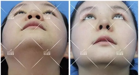 鼻子不是越高越好看！