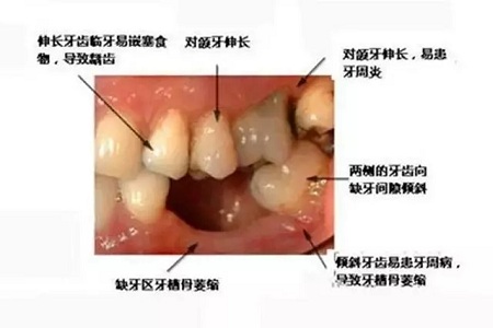 牙齒缺失時，選烤瓷牙還是那種？
