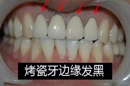 牙齒缺失時，選烤瓷牙還是那種？
