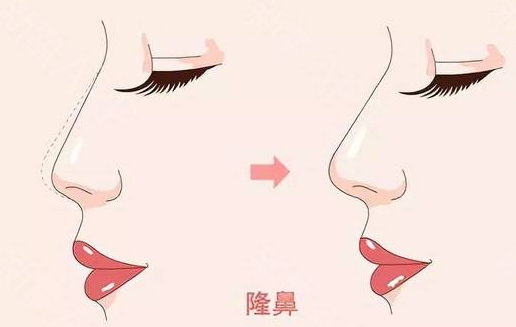 <a href='/zz/' target='_blank'><u>鄭州美萊</u></a>整形醫(yī)院隆鼻有幾種、效果怎么樣？