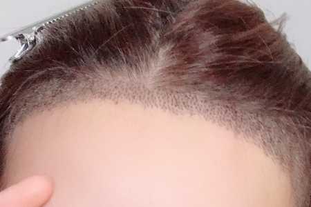 常州發(fā)際線調(diào)整效果好嗎，發(fā)際線如何調(diào)整？