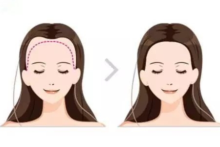 常州發(fā)際線調(diào)整效果好嗎，發(fā)際線如何調(diào)整？