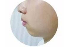 下巴短小后縮怎么辦，重慶整形醫(yī)院墊下巴效果好嗎