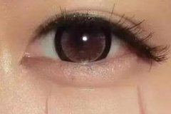 自體脂肪豐臥蠶填幾次有效果，術(shù)后注意事項有哪些