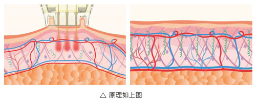 超光子+水光，“撐起”皮膚彈、潤、緊